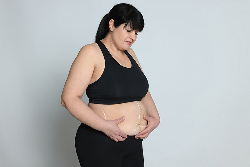 Female patient with obesity considering ESG and bariatric surgery as weight loss treatment options.